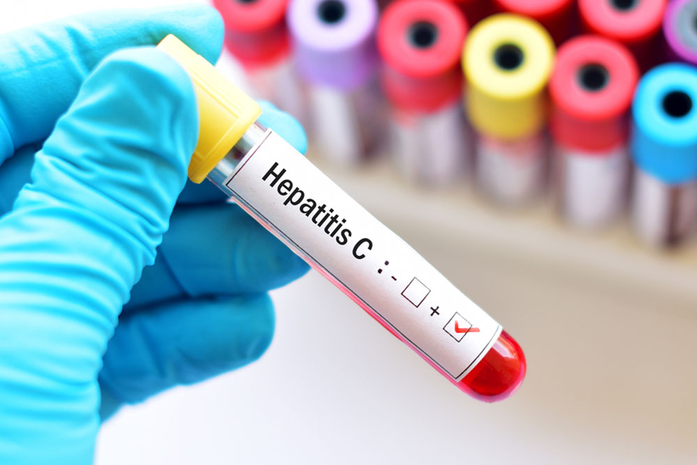 Hepatitis – types and contributing factors