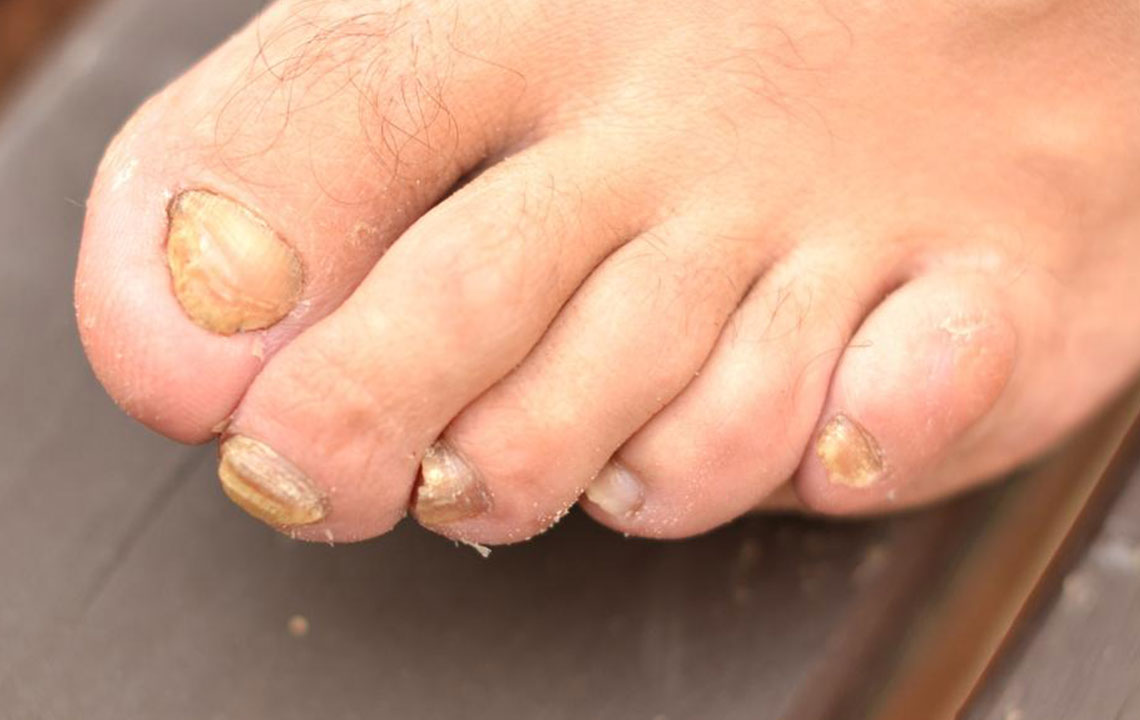 Toenail Fungus – Causes, Symptoms and Treatment